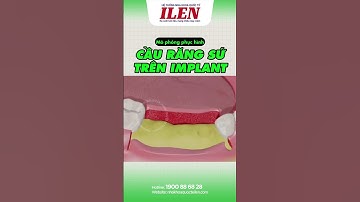 Mô phỏng phục hình CẦU RĂNG SỨ TRÊN IMPLANT #nhakhoaquocteilen