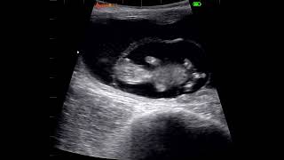 Bovine 63 day pregnancy