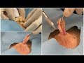 粉瘤epidermoid cyst. ブログでも詳しく解説してます。くりぬき法　心斎橋　神戸三宮　ふるばやし形成外科粉瘤クリニック東京新宿院　大阪梅田形成外科クリニック
