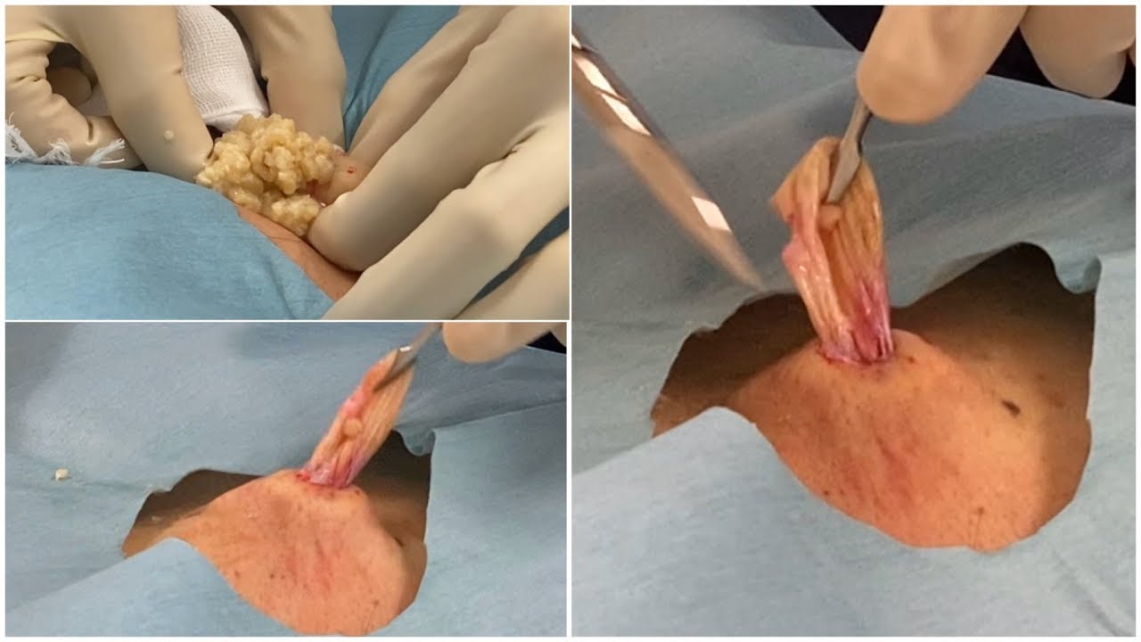 巨大化した粉瘤の摘出動画が怖すぎる まとめも