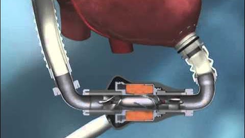 HeartMate II LVAD Animation - YouTube_2