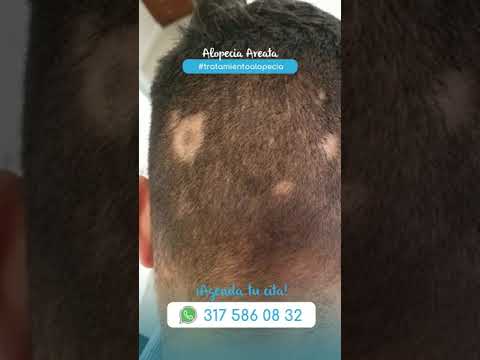 Caída de Pelo