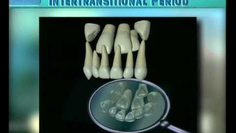Clip 13: Transition of Maxillary Incisors with Shortage of Space