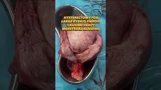 Ruptured Tubal Ectopic Pregnancy in Previous 2 LSCS Patient | Surgical Case | Dr. Tanu Soni