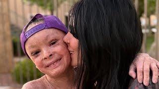 Las Vegas boy who was unable to close his eyes thriving after surgery