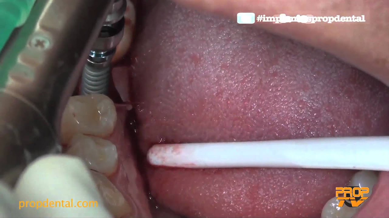 amplio Algebraico Terraplén Colocación de un implante dental | Cirugía de implantes dentales - YouTube