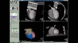 Vitrea CFA Edit LV and RV Contours Demo