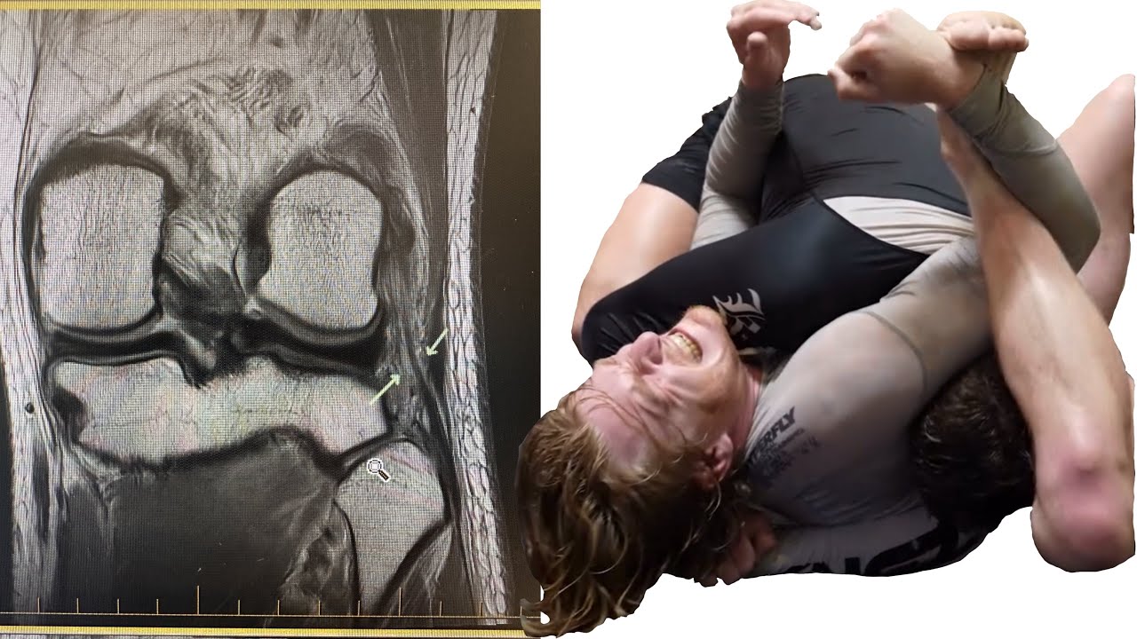 LCL Knee Injury from BJJ