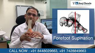 Flat Foot Explained In Detail By Dr. Anuj Chawla