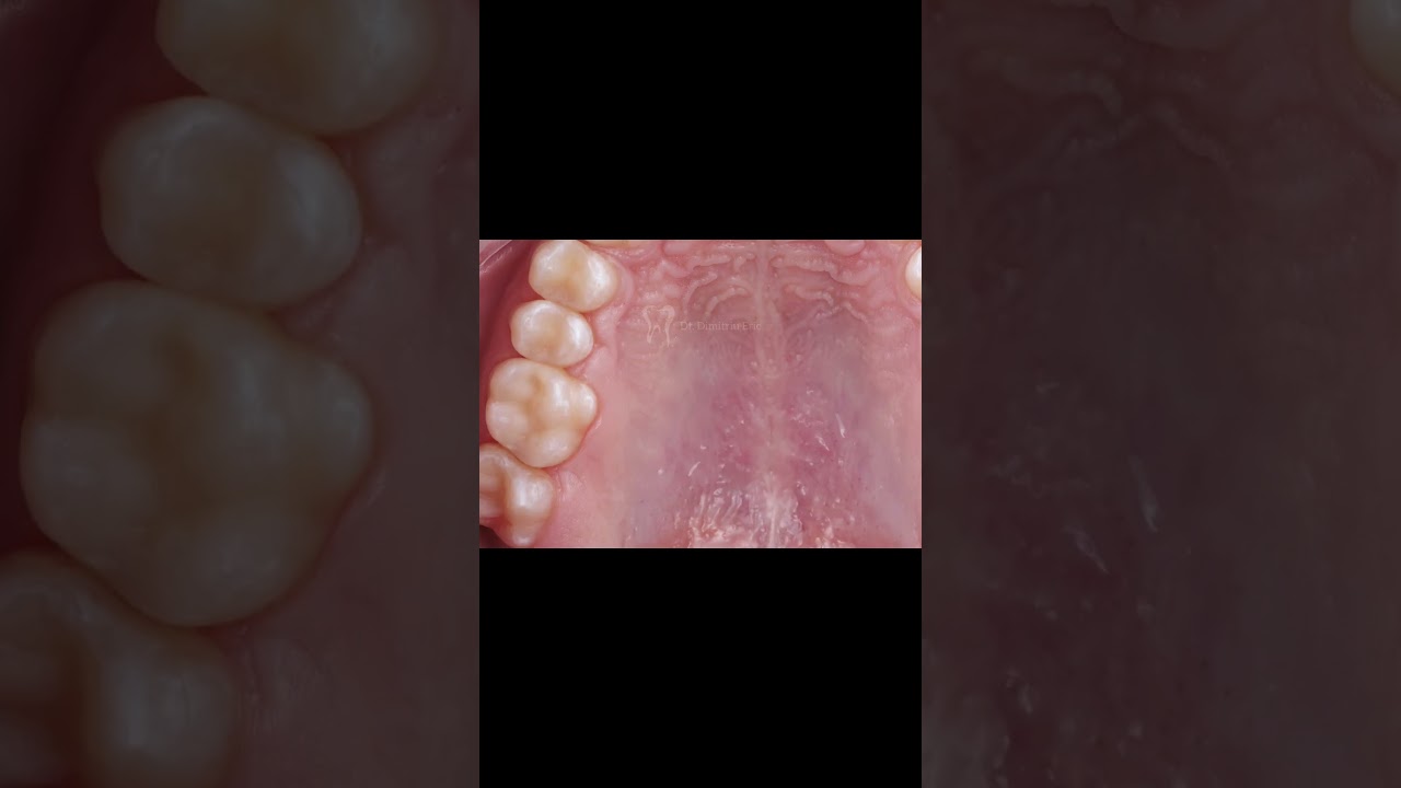 Tooth morphology and fissure anatomy | cinematic case presentation | DentiClips
