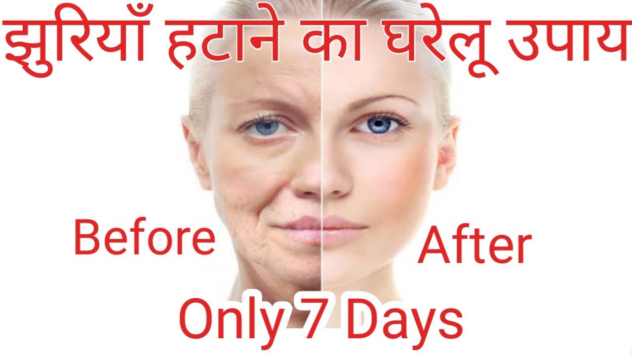 झुरियाँ खत्म करने का तरीका Jhuriya Kaise Hataye. Face se Jhuriya Kaise