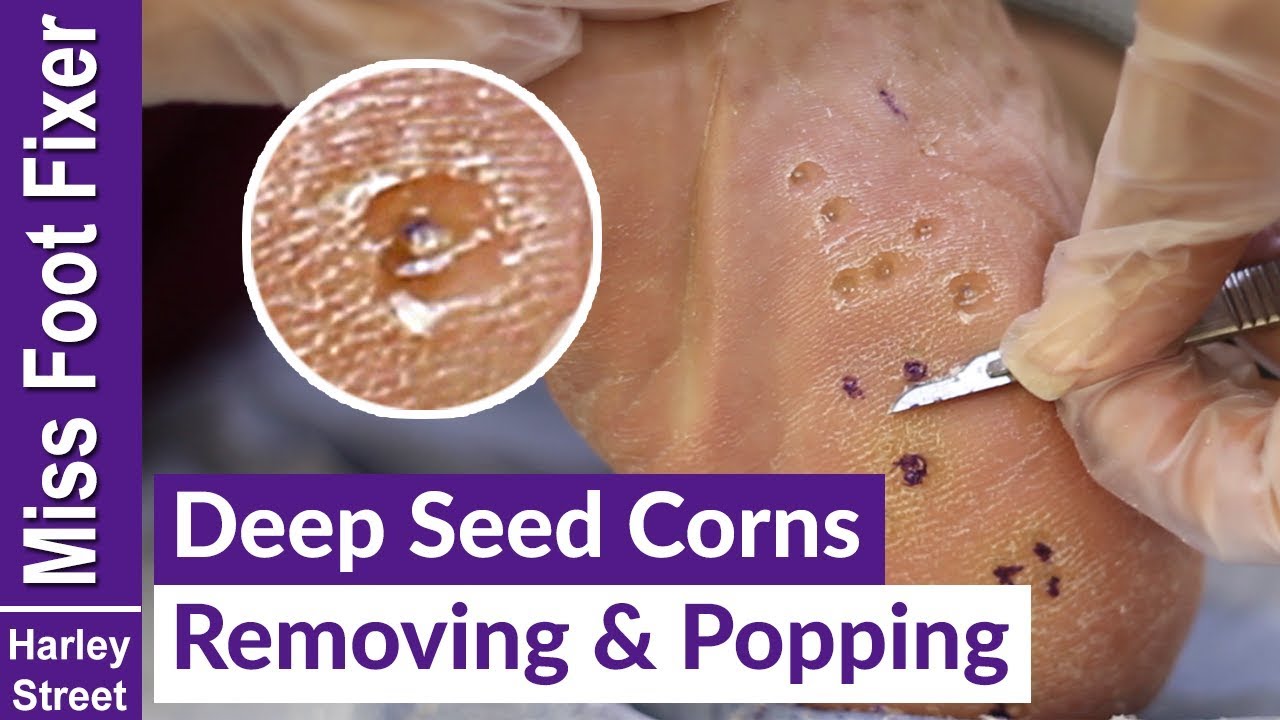 Deep Seed Corns Removing And Popping By Miss Foot Fixer Marion Yau Youtube