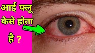 आई फ्लू कैसा होता है || ? EYE FLU