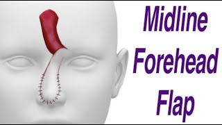 * Midline Forehead Flap with Pictures (Version 2)