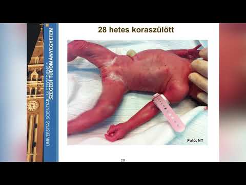 Videó: Hogyan kell kezelni a Placenta Previa -t (képekkel)