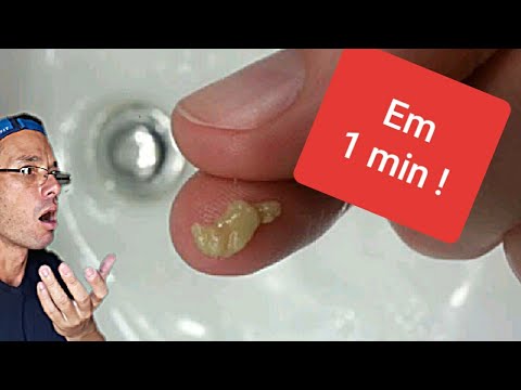 Como remover BOLINHAS FEDORENTAS | CÁSEOS da garganta em 1 MIN !