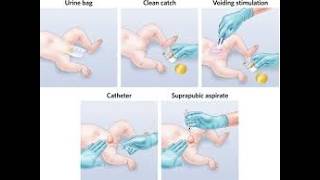 Methods of Urine Collection; Bagging, Clean catch method, Catheterization,