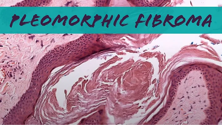 Pleomorphic fibroma (looks like skin tag but relative of spindle cell/pleomorphic lipoma) pathology
