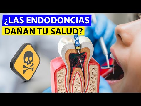 Las endodoncias dañan tu salud, el nuevo tema del que todos hablan. ¿Será cierto?