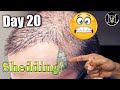 3 weeks after fuedhi hair transplant my experience