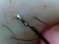 Ingrown Hair 埋没毛の救出!PART3