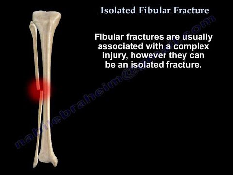 Video: Fractures Of The Fibula