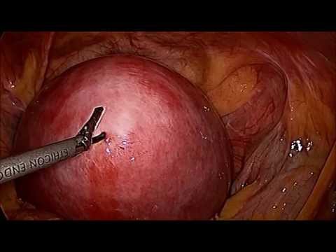 Laparoscopic Fibroid Removal