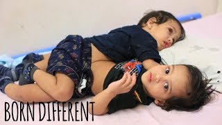 The Conjoined Twin Brothers Who Survived Separation | BORN DIFFERENT