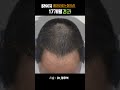 623번 헤어라인 + 정수리 비절개 5000모발이식 모바른 정우석 원장