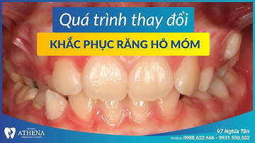Niềng răng mắc cài kim loại - khắc phục răng hô móm 2 | Nha khoa quốc tế Athena