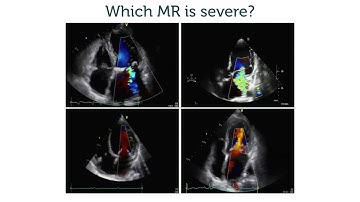 Which of these mitral regurgitations is severe?