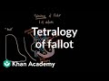 Tetralogy of fallot | Circulatory System and Disease | NCLEX-RN | Khan Academy