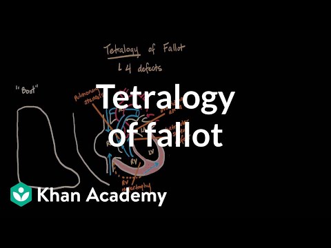 Video: Kan tetralogi af fallot opdages før fødslen?