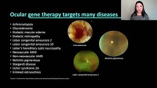 Lecture: The Clinical & Surgical Considerations of Gene Therapy in Retina Patients