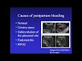 Retained products of conception ultrasound lecture