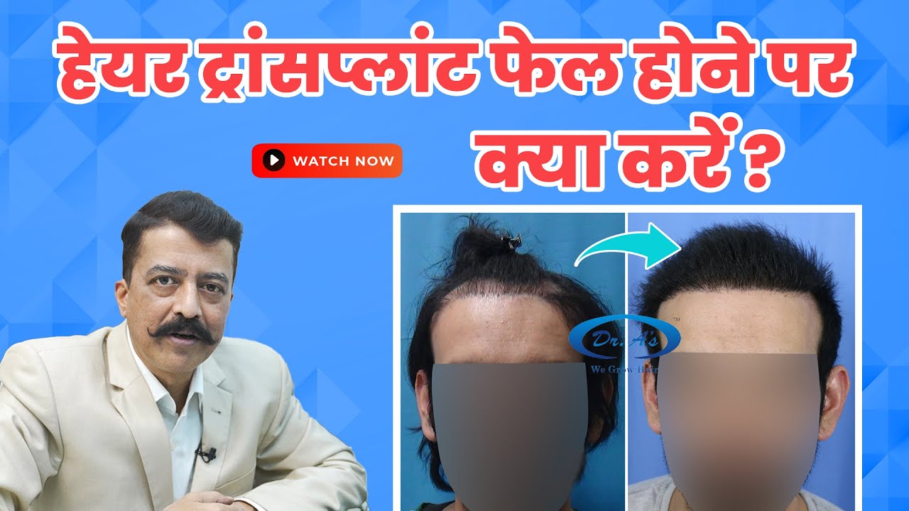 💇🏻Hair Transplant Repair In Hindi हेयर ट्रांसप्लांट फेल होने पर क्या करें By Dr. Arvind