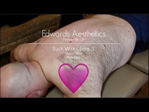 Edwards Aesthetics | Back Wax | Client 3 | Starpil Pink |