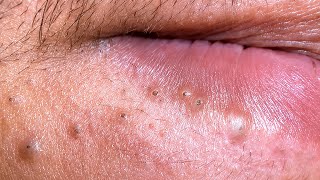 [ASMR] Acne Prone Skin Routine | Deep Cleansing, Pore Care &amp; Final Glass Skin Glow