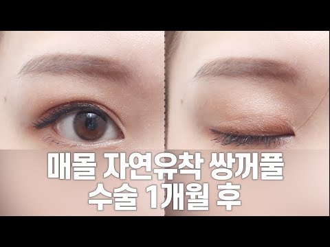 매몰 자연유착 쌍꺼풀 수술 후 1개월 영상/흉터 영상  l 강남서연성형외과