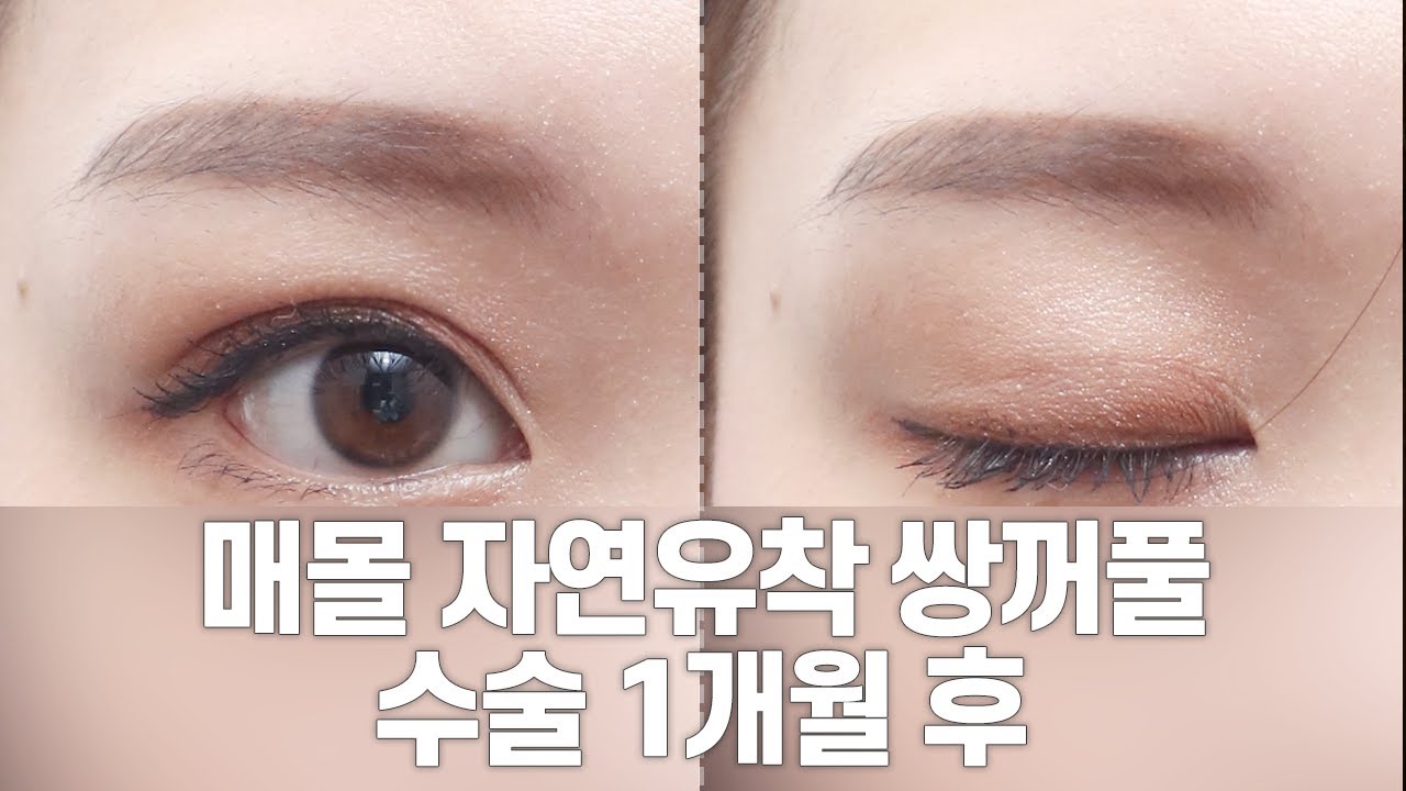 [Bệnh viện thẩm mỹ Gangnam Seoyeon] Video 1 tháng sau phẫu thuật mắt hai mí tự nhiên không rạch da/Video sẹo l Bệnh viện thẩm mỹ Gangnam Seoyeon