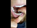 Réponse D Un Orthodontiste Comment Utiliser Le Fil Dentaire Avec Un Appareil De Contention Coll mp3
