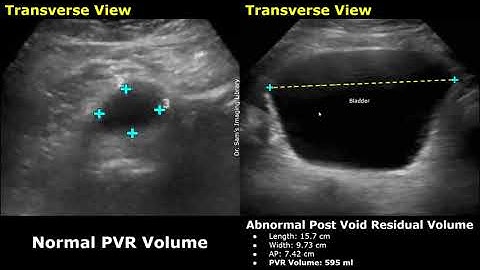 Pre Void & Post Void Residual Volume Bladder Ultrasound Normal Vs Abnormal Images | PVR USG