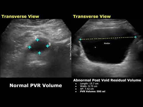 Pre Void & Post Void Residual Volume Bladder Ultrasound Normal Vs