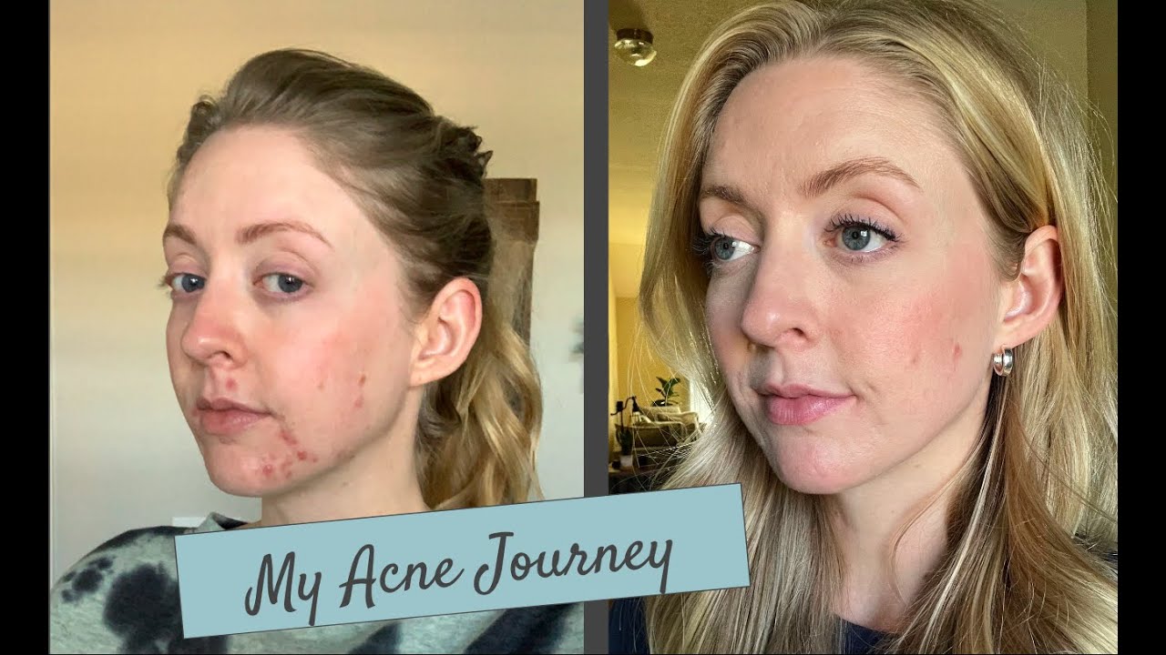 ACNE JOURNEY - MY Side Effects on Spironolactone and Doxycycline