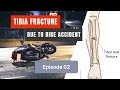 Tibia and fibula fractured Ep. 02: Operation Day and Discharge