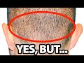 Does FUE Hair Transplant Leave SCARS Dr Gary Linkov 