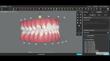 Leading Invisalign orthodontist shows some of his standard clincheck modifications