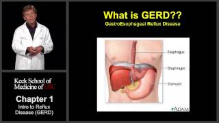 Chapter 1: GERD and the Progression to Esophageal Cancer