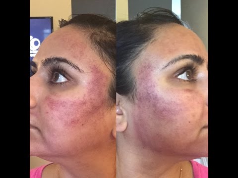 Acne Scar Resurfacing | Collagen Induction Therapy/Medical Grade Micro-needling | VLOG & My Story