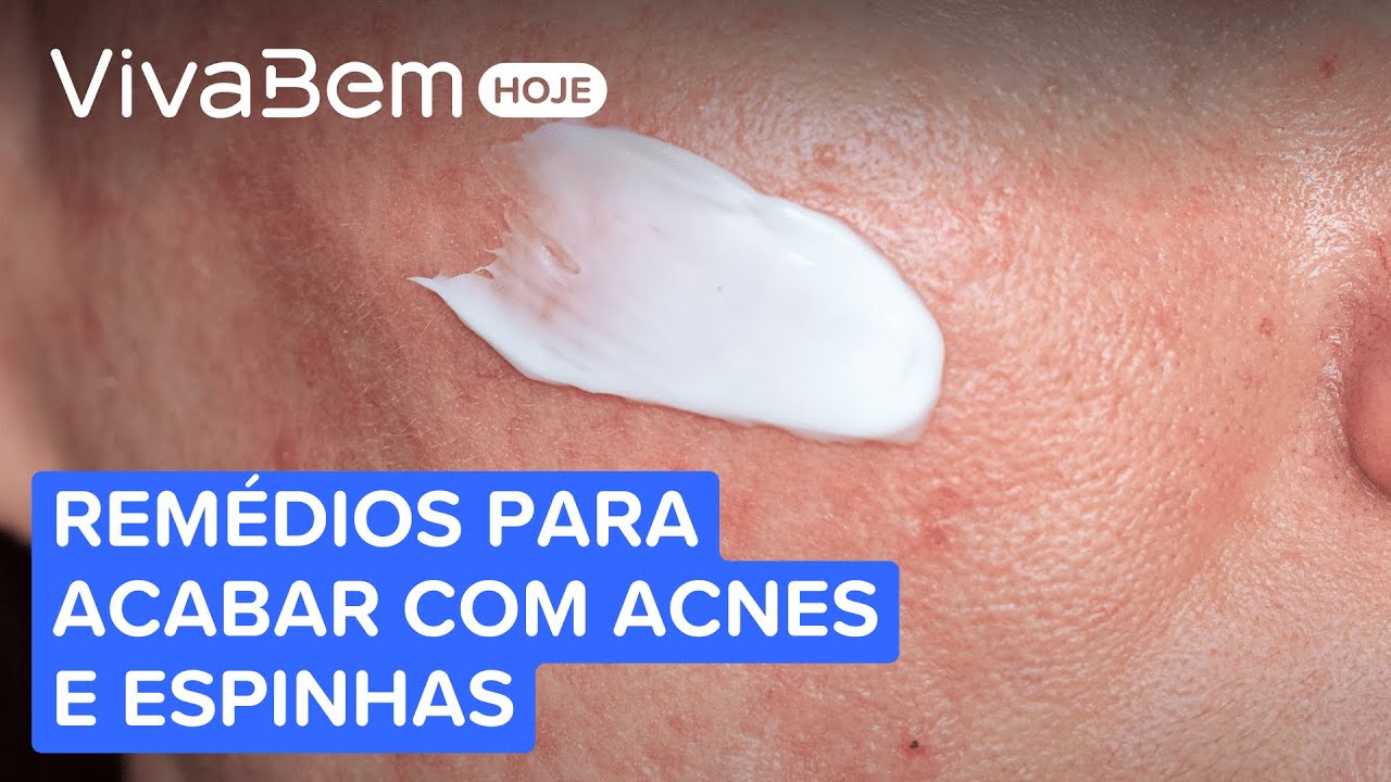 Como Se Livrar Das Espinhas Com Remedios Caseiros Como Tirar Espinhas